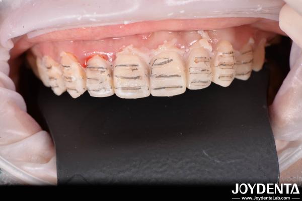Finition dentaire composite durable Bonne biocompatibilité Pas de goutte de finition de porcelaine