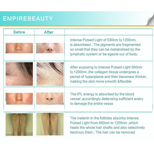 Medical Equipment CE Approved Laser IPL /SHR/ OPT hair removal machine portable ipl