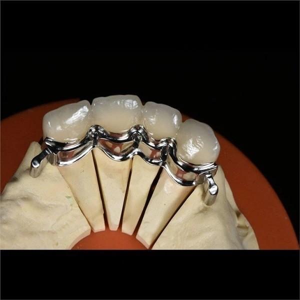 Aesthetic Precision Dental Implant Ball Attachment Partial Dentures