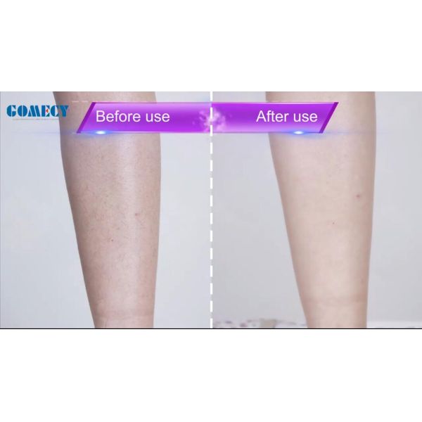 Pain Free Laser Hair Removal Machines 12*12mm Spot SHR Laser 808nm Fiber Laser Hair Removal Machine