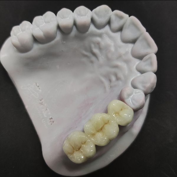Ceramic Zirconia Dental Lab Crown Custom Anterior Posterior Teeth Replacement