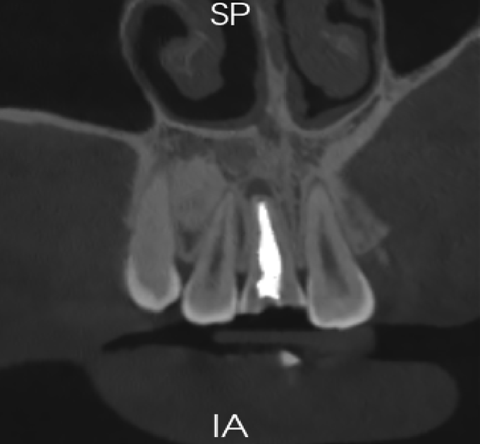 Dental Implant Orthodontic CBCT System High-Resolution 3D Imaging for Precise Diagnosis