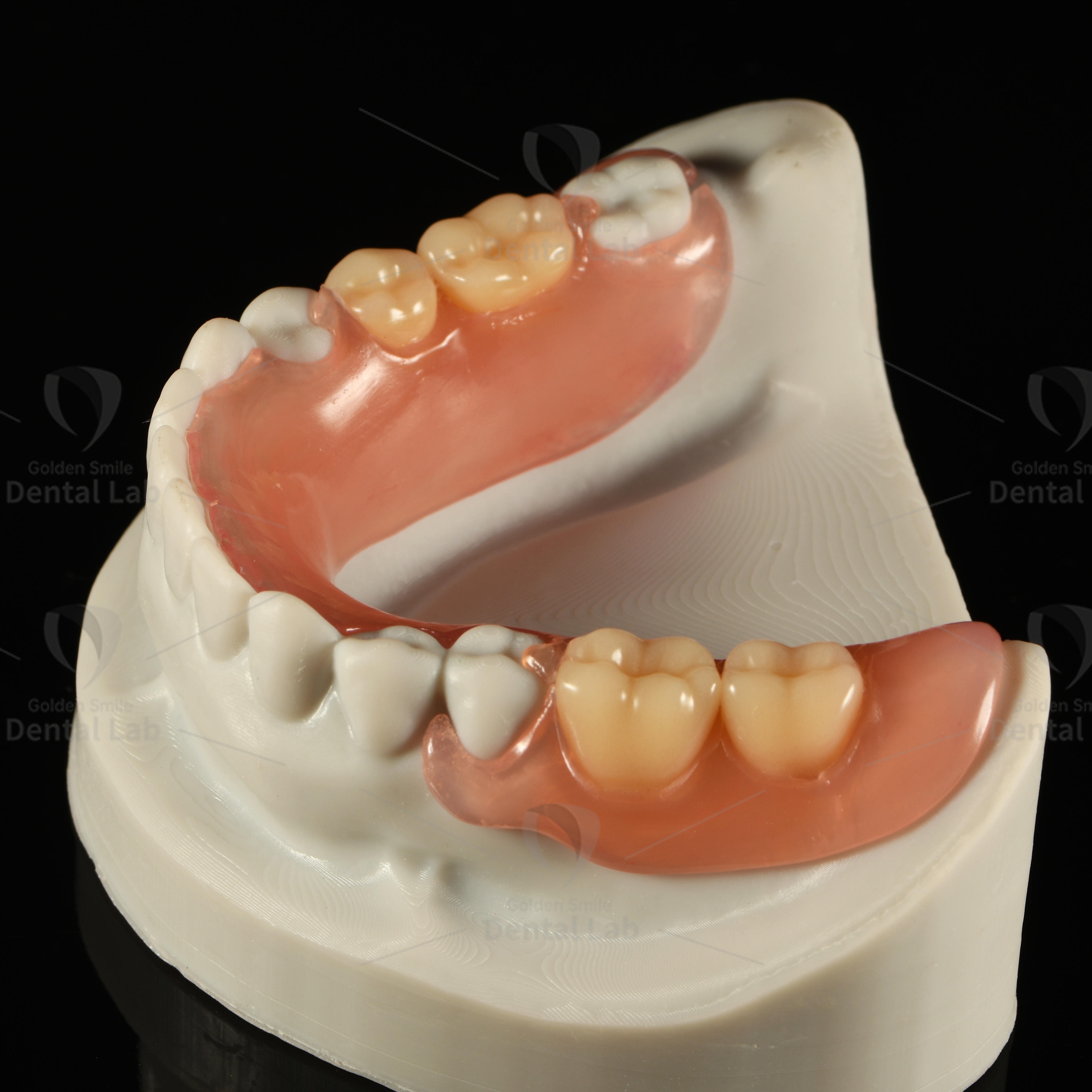 Full Acrylic Resin Removable Partial Denture