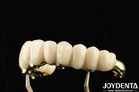 Comfortable To Wear Ti-Bar Zirconia Hybrid Bridge Restores Chewing Function Compatible With Natural Teeth And Gums