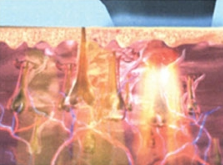 Beauty Salon Diode Laser Hair Removal Machine IPL / SHR Technology With LCD Display