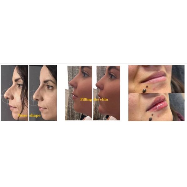 Штраф/Derm/глубокий Ha стороны заполнителя заполнителя Hyaluronic кисловочной сморщивают 5ml