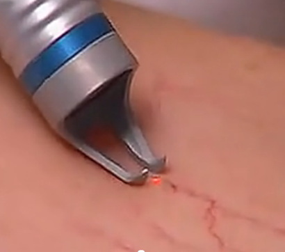 portable Diode 980nm laser for vascular removal machine