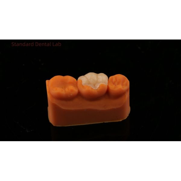 Strength Emax Ceramic Crown Dental Onlay with Excellent Stain Resistance China Dental Lab