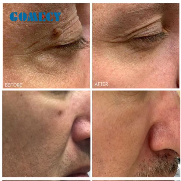 Fractional Laser Equipment 110V 220V Laser Acne Scar Removal Machine Spot Size 0.02-0.05mm2