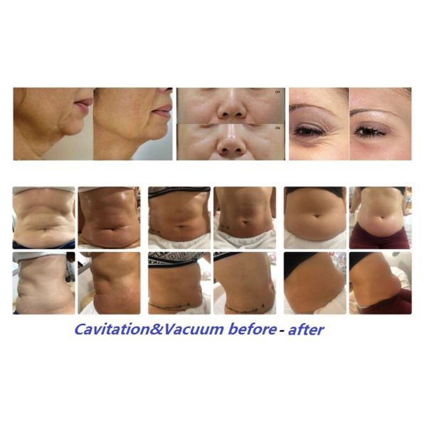 Radio Frequency Rf Body Slimming Machine Vacuum Cavitation Slimming 1000kpa