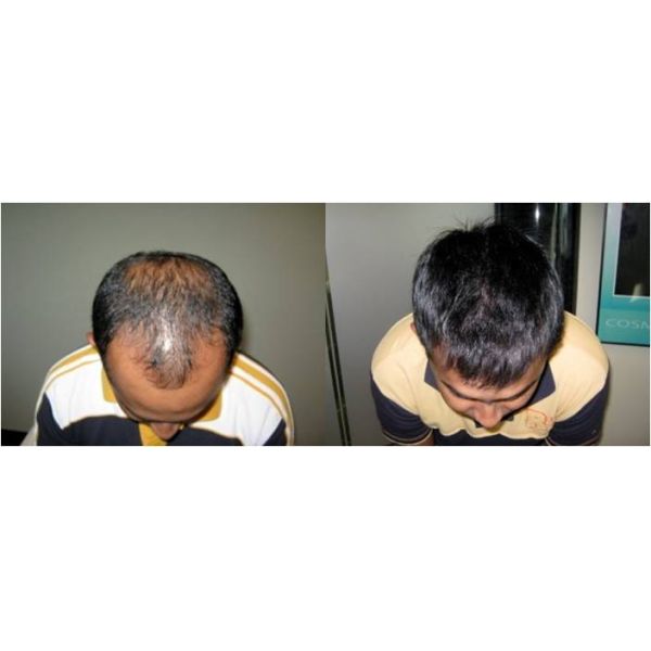 FDA Cleared Pro Laser Hair Regrowth Helmet 650nm 405mW Anti Hair Removal