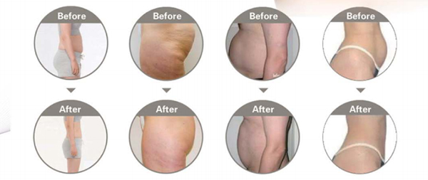 40KHz Body Slimming Machine Ultrasonic RF Vacuum Cavitation Machine