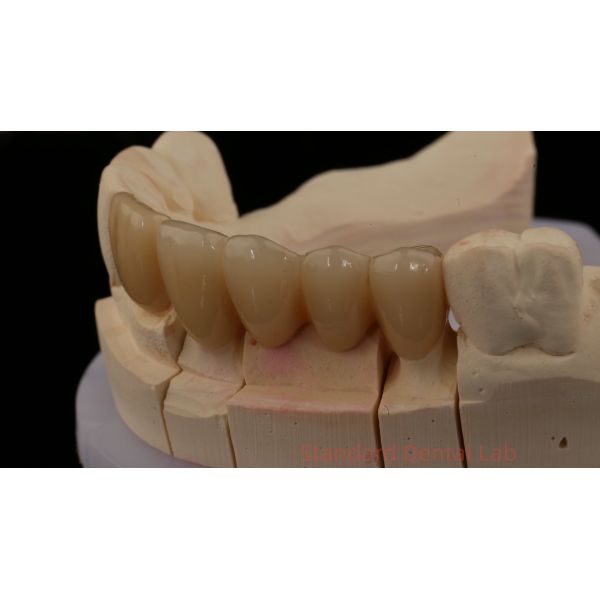 Noritake Porcelian Full Contour Zirconia Crown High Aesthetic Natural Customized Zirconia Dental Bridge