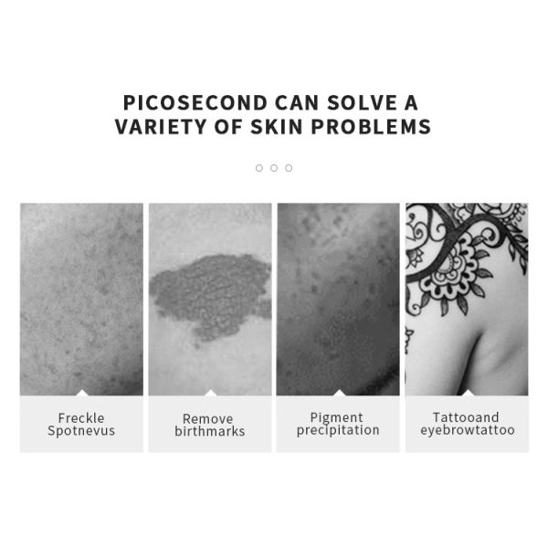 Q Switched ND Yag Laser Tattoo Removal Machine 1064nm Picosecond Laser Tattoo Removal Machine