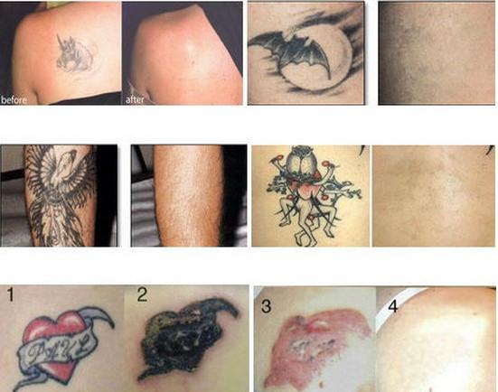 2016 High quality Q switch nd yag tattoo removal laser machine 