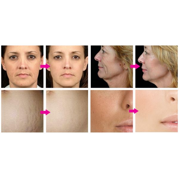 Коммерчески машина Rf Microneedle Rf красоты подмолаживания кожи