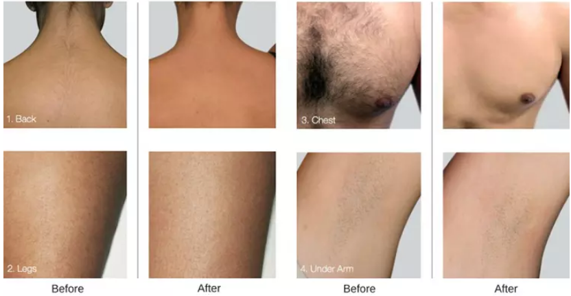 Оборудование красоты лазера диода 755 808 1064 подмолаживаний кожи удаления волос