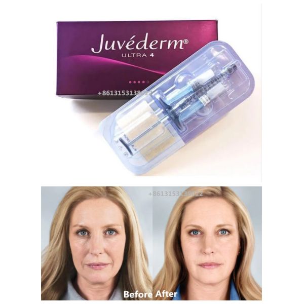 Juvederm Dermal Filler Juvederm Ultra4 HA Dermal Filler Juvederm объем