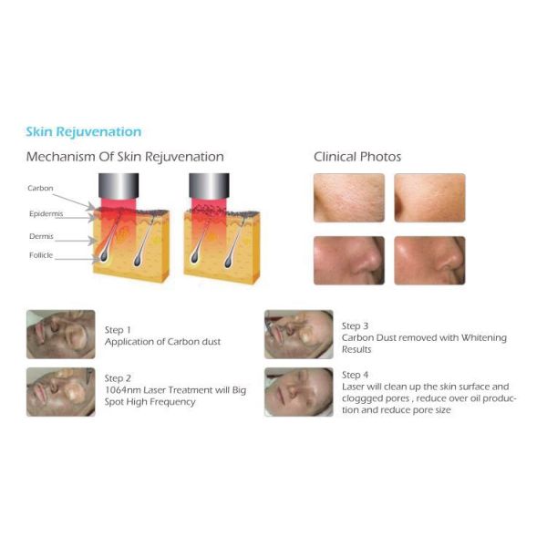 2000mj 1064nm 532nm 755nm Nd Yag Picosecond Laser Tattoo Removal Machine