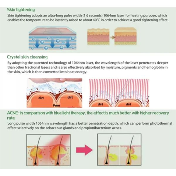 Máquina 1064 del laser del Alexandrite del Nd YAG permanente del retiro del pelo de 755 lasers