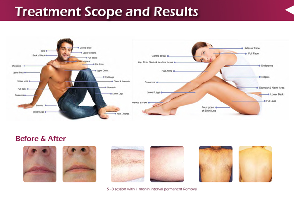 laser diode 500mw green professional laser hair removal equipment