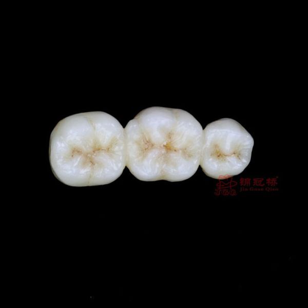 Dental Pfm Crown And Bridges Pontic Dentures Materials Dental Restorations