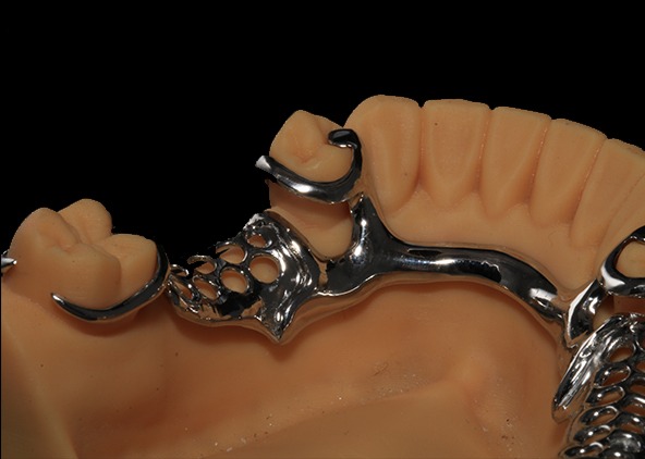 High Strength 3D Printed Argen Dental Framework With Clear Clasps
