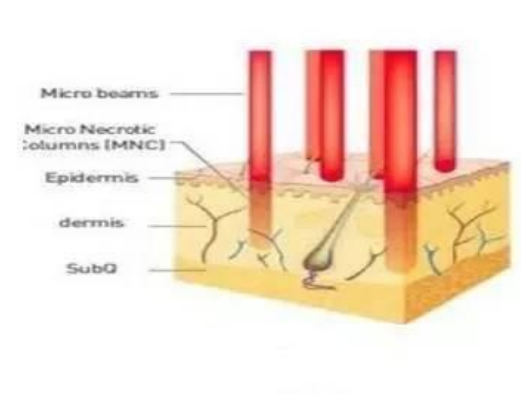 Gold Radio Frequency Body Skin Tightening Machine Facial Radio Frequency Machine