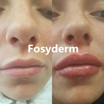 Línea atractiva transparente llenadores cutáneos de Derm del ácido hialurónico de los labios 1ml del labio del gel