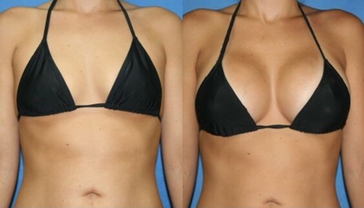 Hyaluronic Acid Breast Augmentation Injection Filler , Breast Enlargement Fillers
