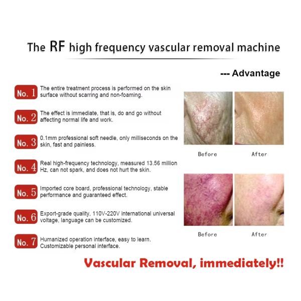 Professional Galvanic Electrolysis Hair Removal Machine with Insulated Precision Needles
