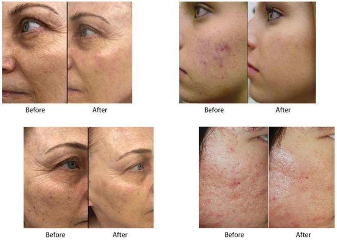 Частичная микро- машина удаления лазера Марк простирания RF иглы