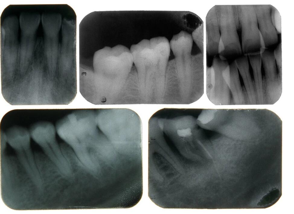 Легкий беспроводной портативный стоматологический рентгеновский аппарат ODM