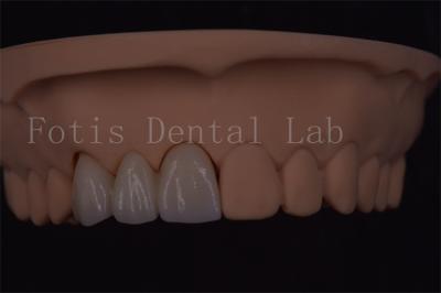 ISO Certified Digital Dental Crowns For Tooth Implant Various Size