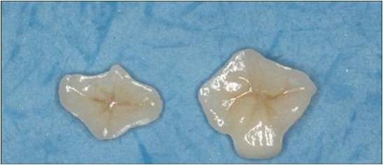 Natural Looking All Porcelain Veneers EMAX Dental Crown