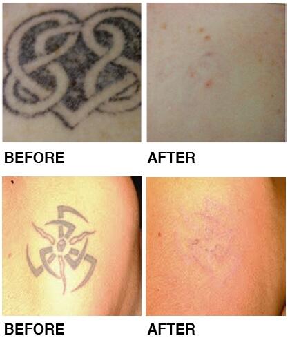 Skin Lightening Q Switched ND YAG Laser Machine For Facial Beauty Two Head