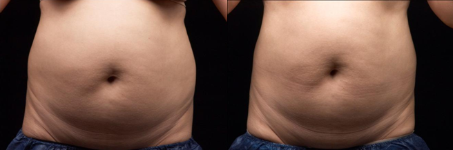 Не инвазионное тело контуря ультразвуковую машину удаления волос кавитации липосакции для дам