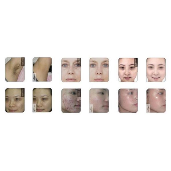 SHR Handpieces IPL Hair Removal Machines / Skin Rejuvenation Machine