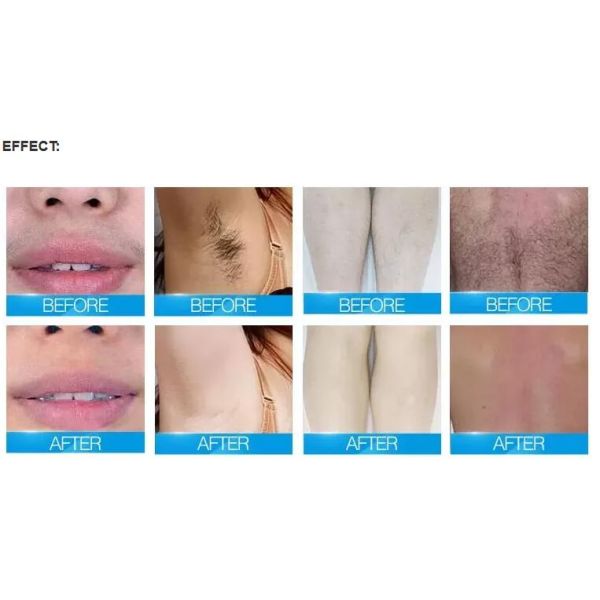 Vertical Medical Salon Laser Hair Removal Machine Non Channel 808nm Type