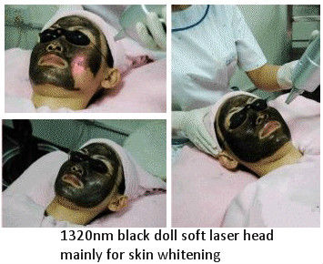 portable q-switch nd yag laser tatoo removal machine