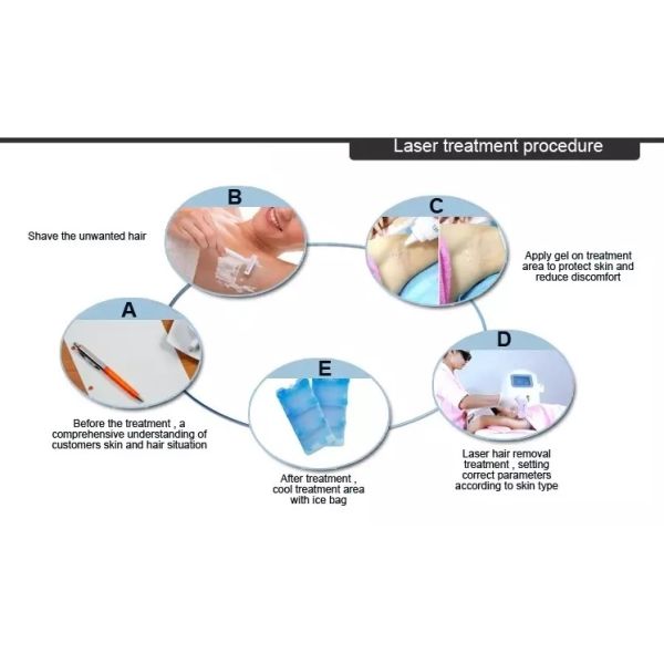 Новая безболезненная 808nm диодная лазерная эпиляция для клинического использования