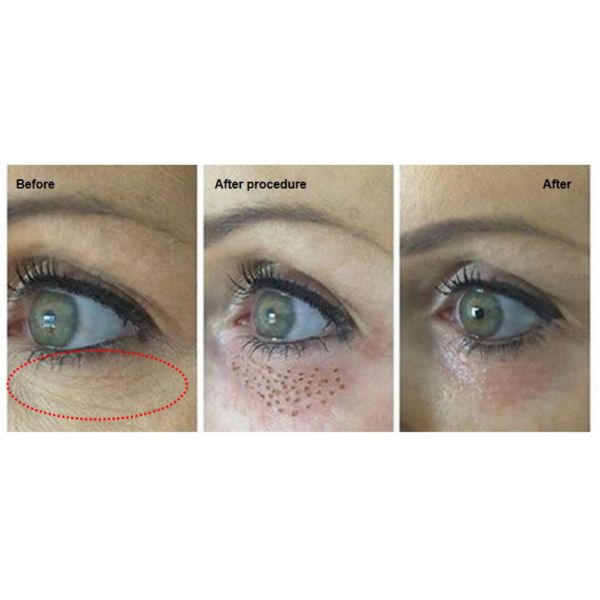 Skin Lifting Skin Rejuvenation Machine For Acne Removal Eyelid Lifting