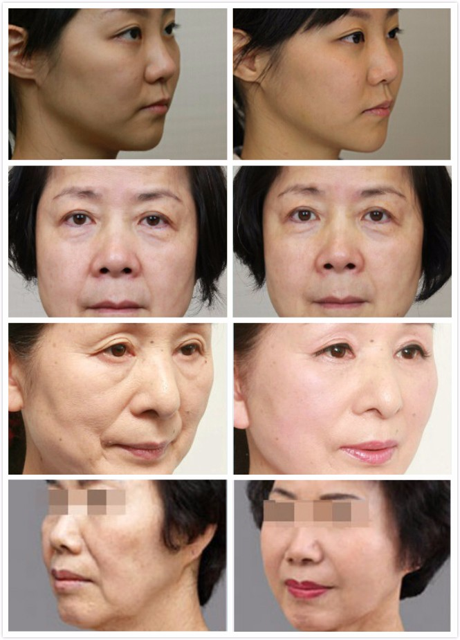 Высокая интенсивность сфокусировала уменьшение морщинки машины красоты ультразвука анти-