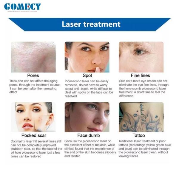 remoção Q-comutada 532nm 1064nm 1320nm das pigmentação da tatuagem do laser do Nd Yag