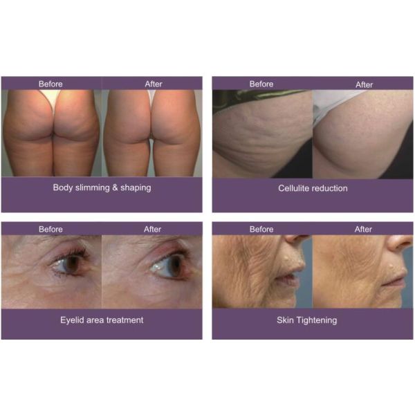 вакуумируйте Вела длинноволновой части инфракрасной области массажа ролика РФ липосакции машины потери веса двухполярные