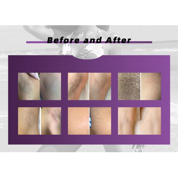 Diode Body Hair Removal 808nm 755nm 1064nm Laser Depilation Machine