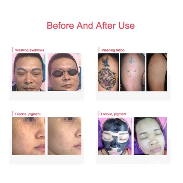 Q Switch Nd Yag Laser Equipment , Eyebrow / Freckle / Tattoo Removal Machine