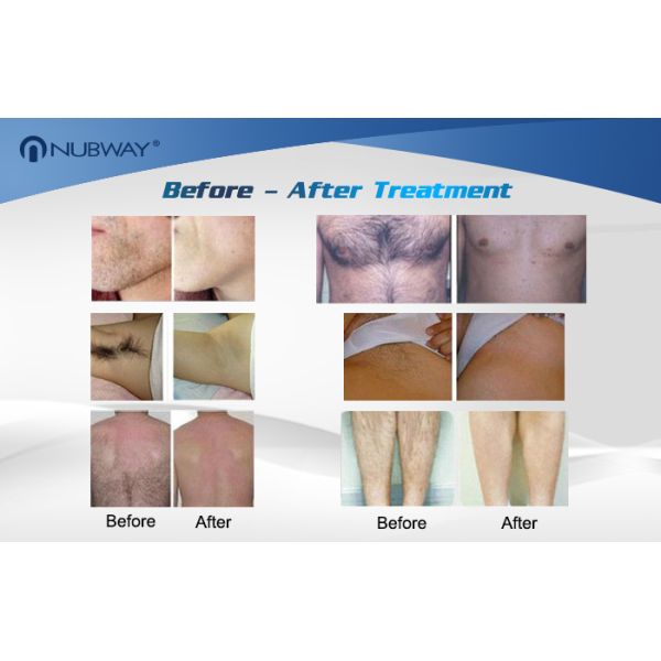 High power 808nm diode laser hair removal machine with CE certification