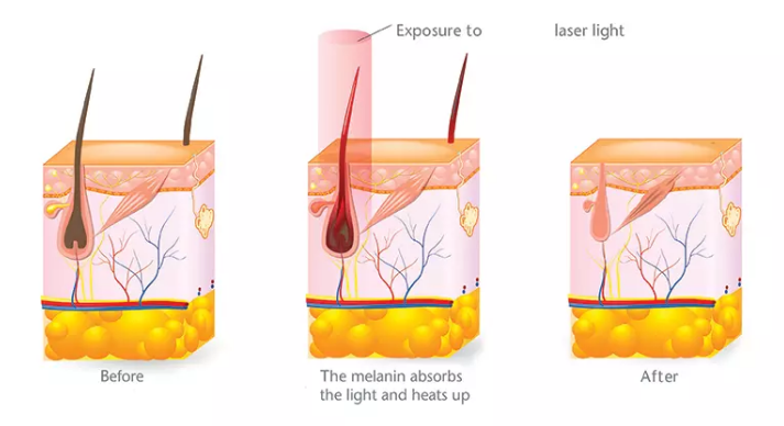 Alexandrite laser hair removal, diode laser hair removal machine,808nm diode laser