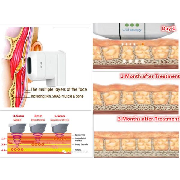 800 W 3.5mm Cartridges High Intensity Focused Ultrasound Machine 4 J / Cm2
